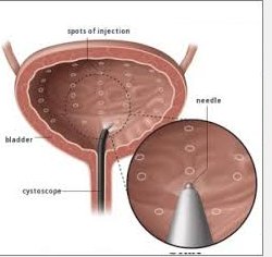 female incontinence treatment